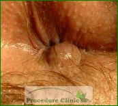 Lump In Anal Area 48